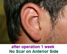 plastic-surgery-prominent-ear 